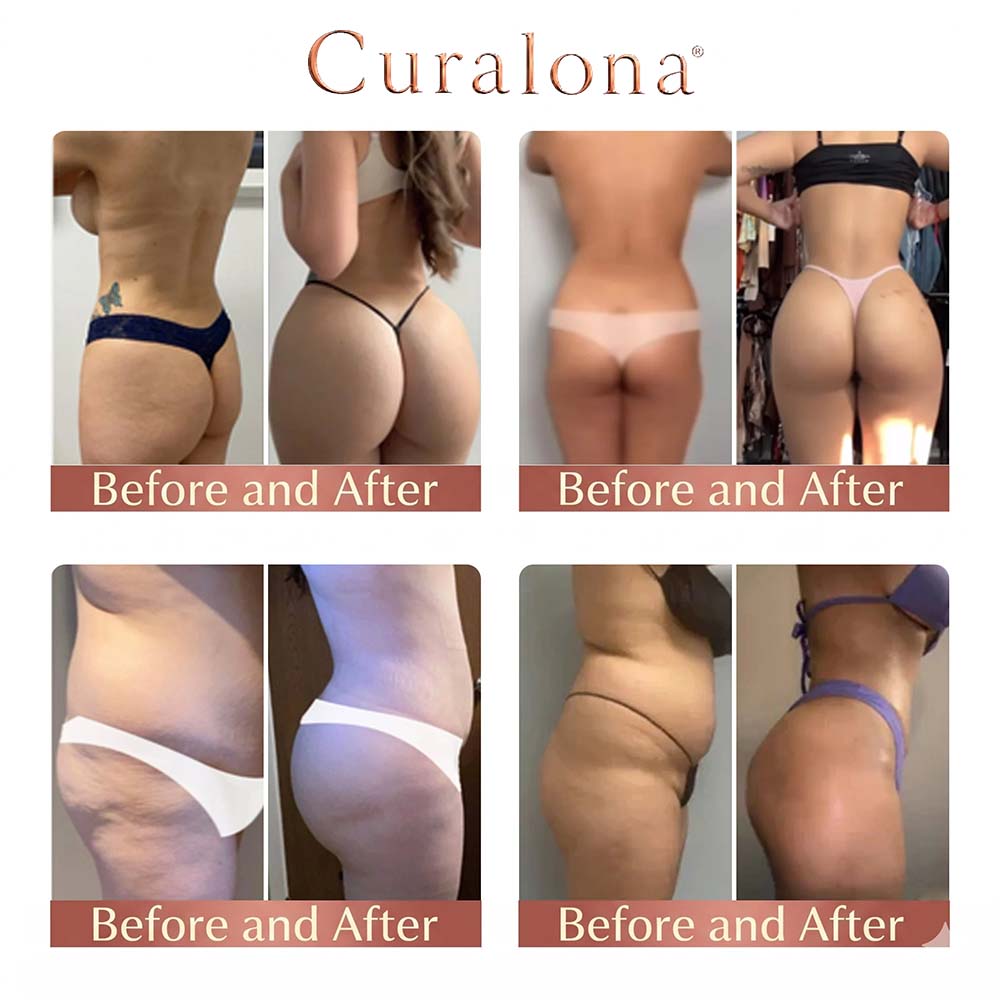 Curalona® CurveSculpt Micro-Patch ✦ Sculpt • Firm • Smooth Lower Body Curves ✦ Micro-Needle Infusion System