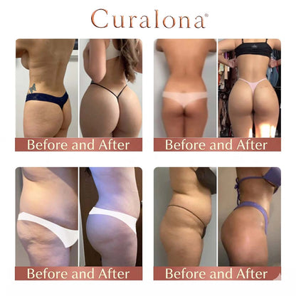 Curalona® CurveSculpt Micro-Patch ✦ Sculpt • Firm • Smooth Lower Body Curves ✦ Micro-Needle Infusion System