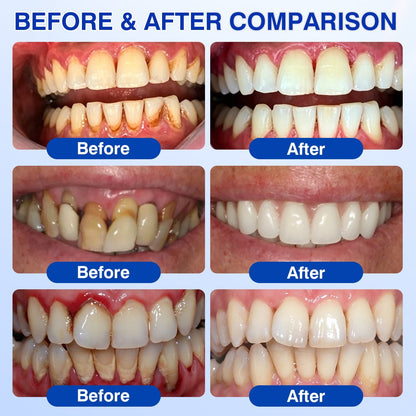 🦷𝐏𝐔𝐑𝐄𝐋𝐎𝐑𝐀® GumRevive Periodontal Repair Gel (for bleeding gums, receding gums, and loose teeth)