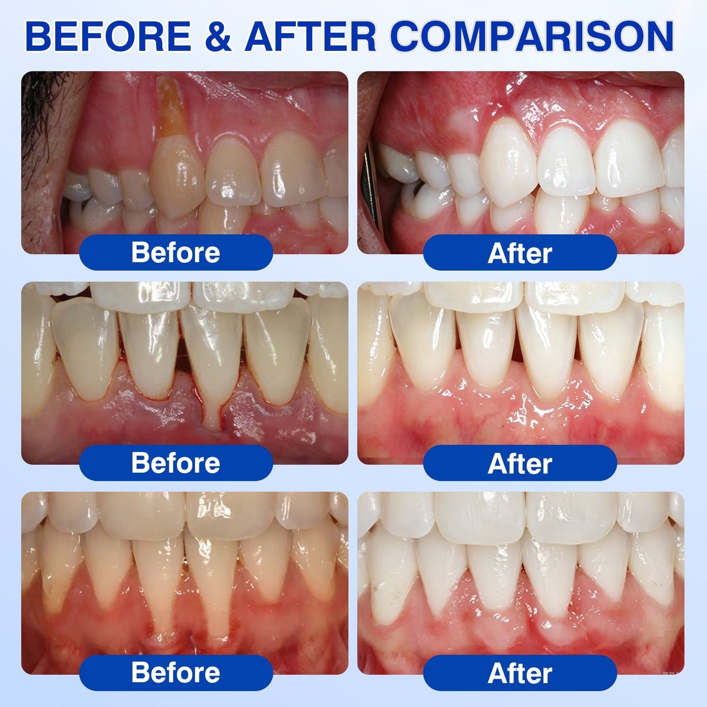 🦷𝐏𝐔𝐑𝐄𝐋𝐎𝐑𝐀® GumRevive Periodontal Repair Gel (for bleeding gums, receding gums, and loose teeth)