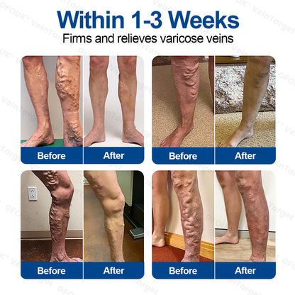 🇬🇧👨‍⚕️✨ CURALONA® VeinTarget Microneedle Patch ⚡ Fast Relief, Long-Lasting Support
