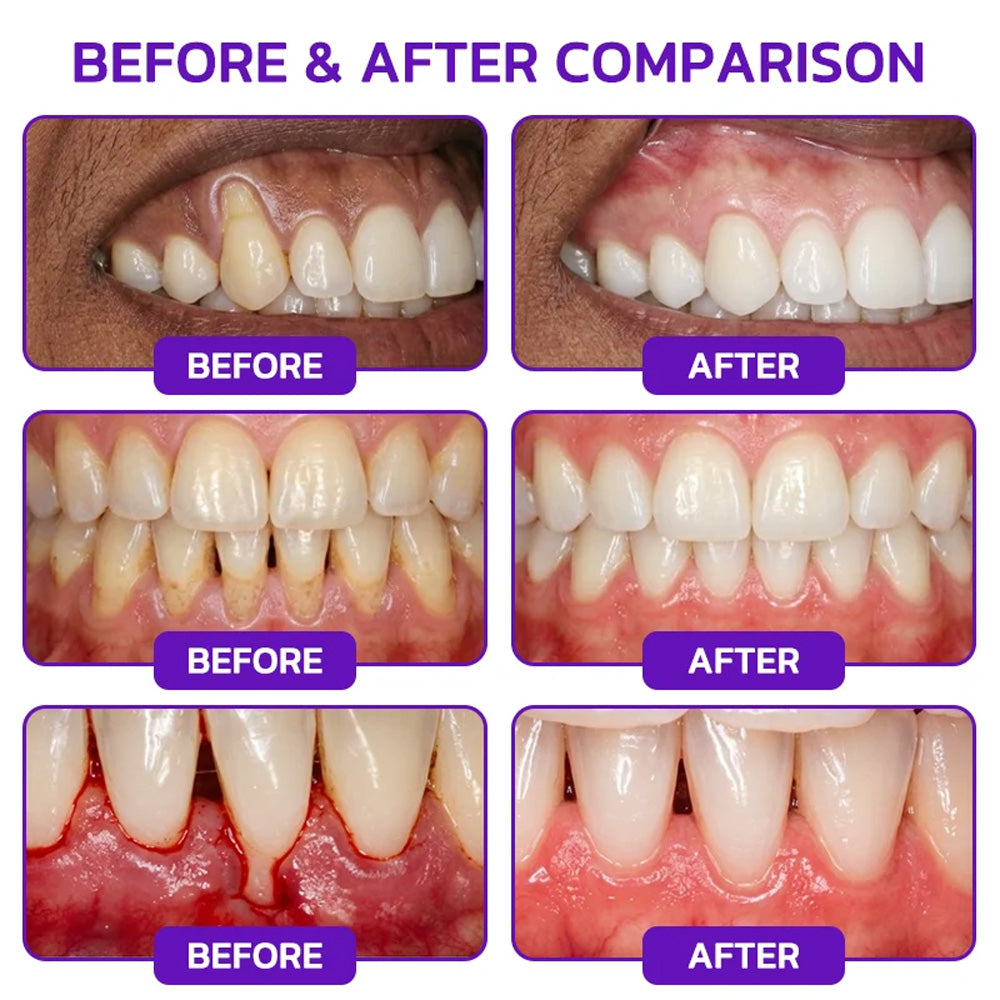 Purelora® VioGum Gingivitis&Periodontal Rescue Gel