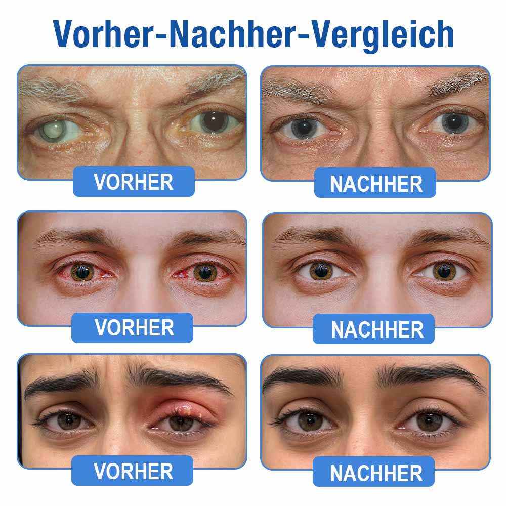 👨‍⚕️ Purelora ® LensClarity Eye Drops✅For dry eyes, blurry vision & presbyopia 💦