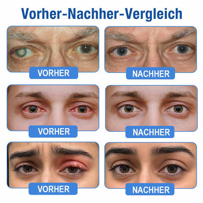 👨‍⚕️ Purelora ® LensClarity Eye Drops✅For dry eyes, blurry vision & presbyopia 💦